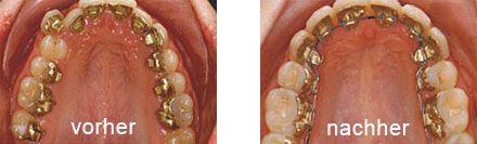 Kieferorthopädiesche Behandlung Zahnspange